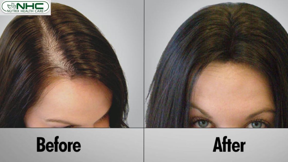 treatment for hair loss alopecia